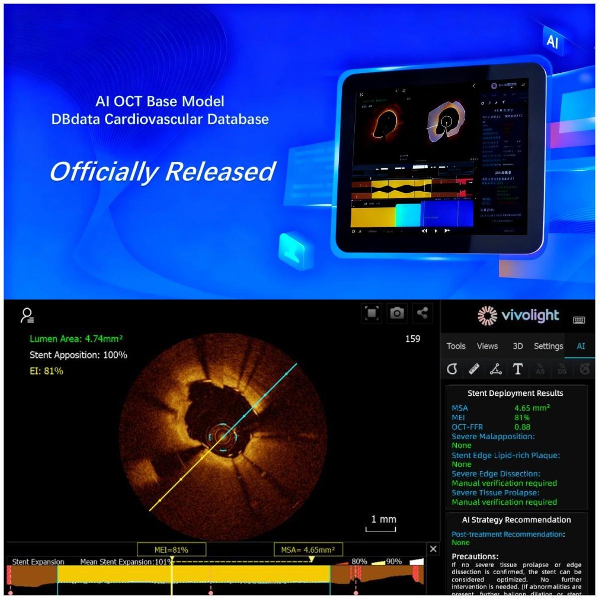 Wir folgen nicht – wir definieren! Chinas intravaskuläre Bildgebung tritt in ihr „DeepSeek“-Zeitalter ein: Vivolight Medical bringt sein KI-OCT-System auf den Markt.